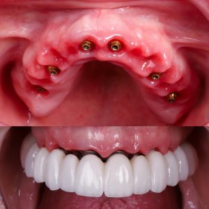 foto de implantes boca completa en el día