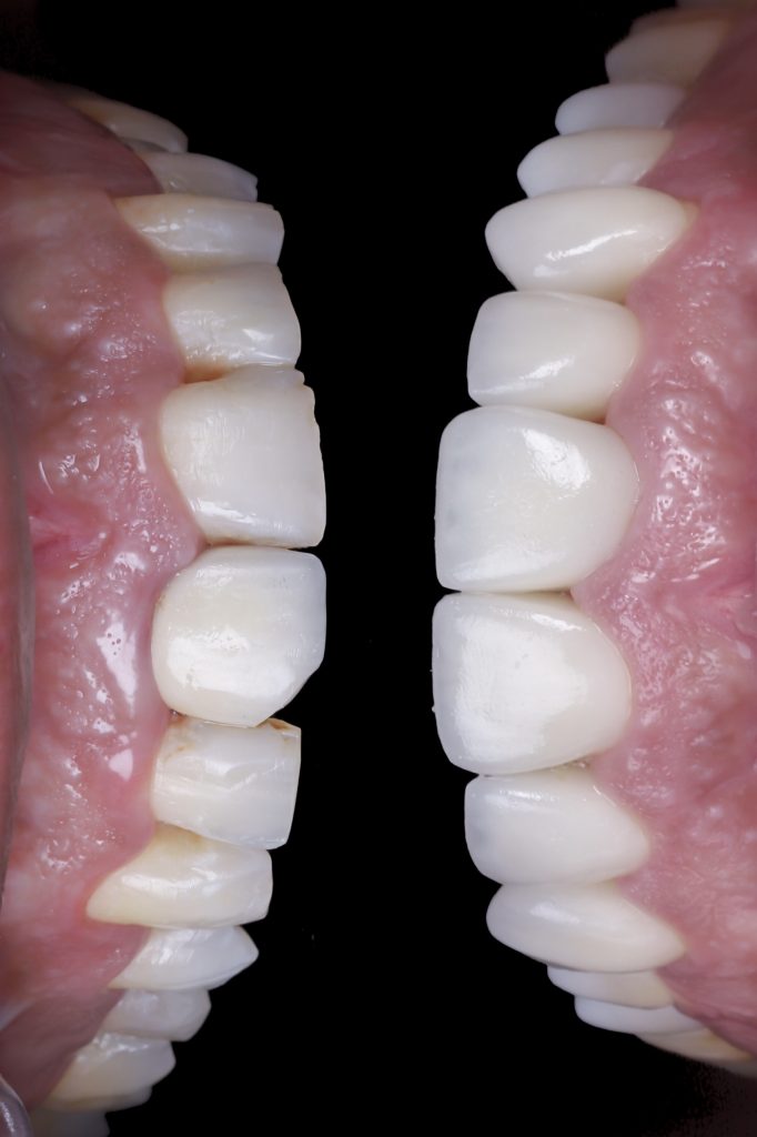 fotos carillas antes y después