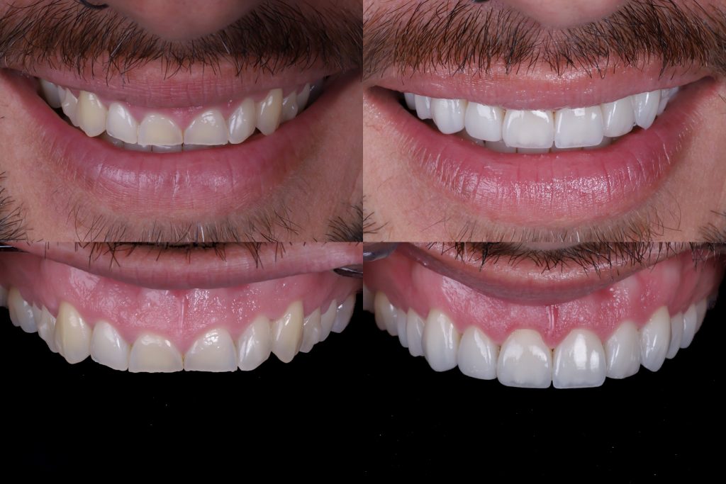 caso real de carillas dentales en madrid