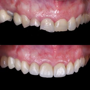 fotos carillas antes y después