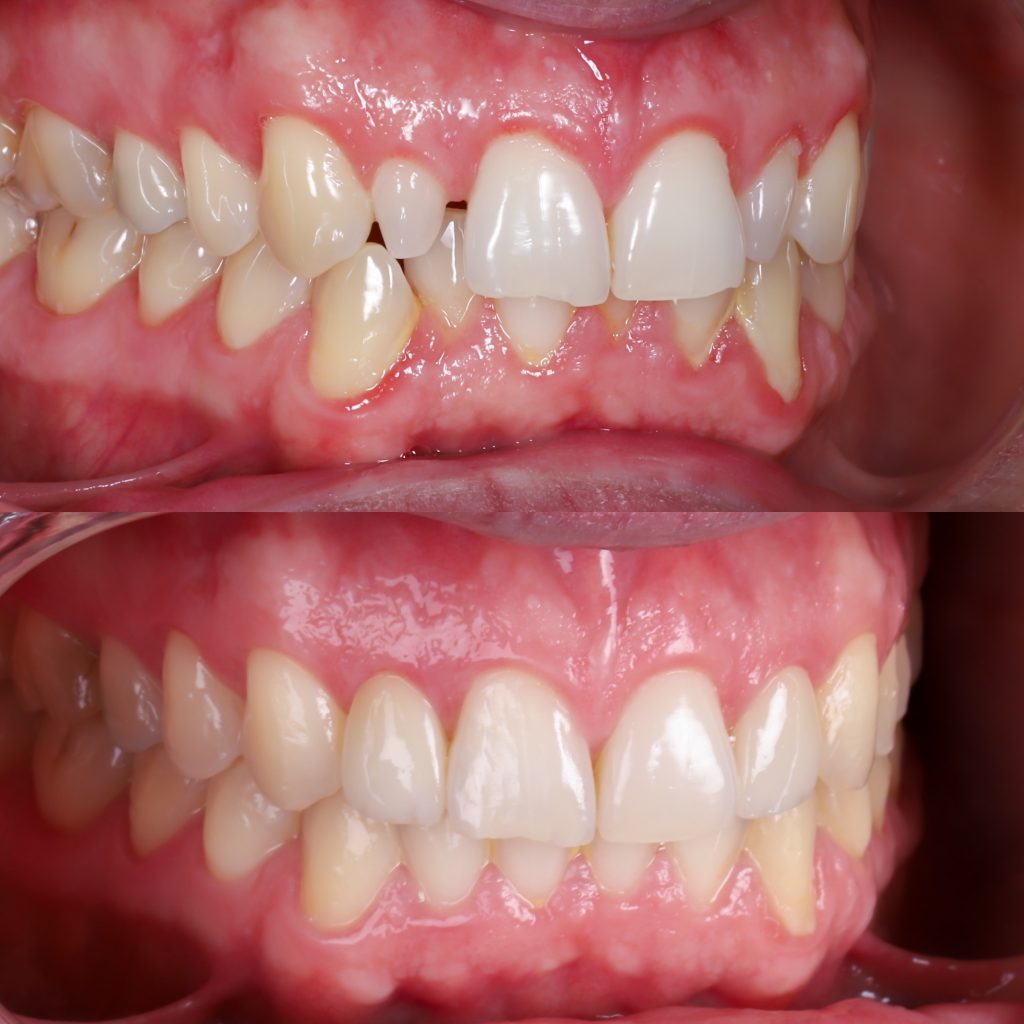 fotos carillas antes y después