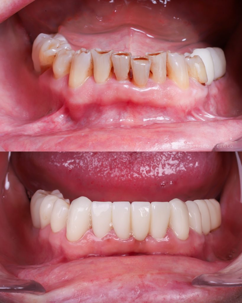 foto de implantes en el día con carga inmediata