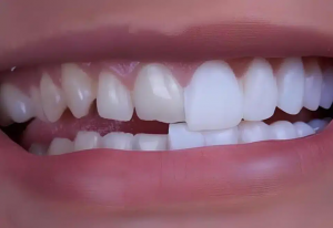 foto de carillas de composite antes y después