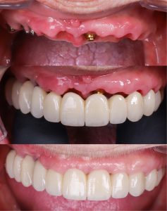 como queda un implante dental 