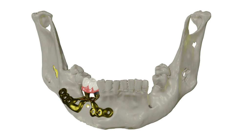 imagen de implantes yuxtaóseos