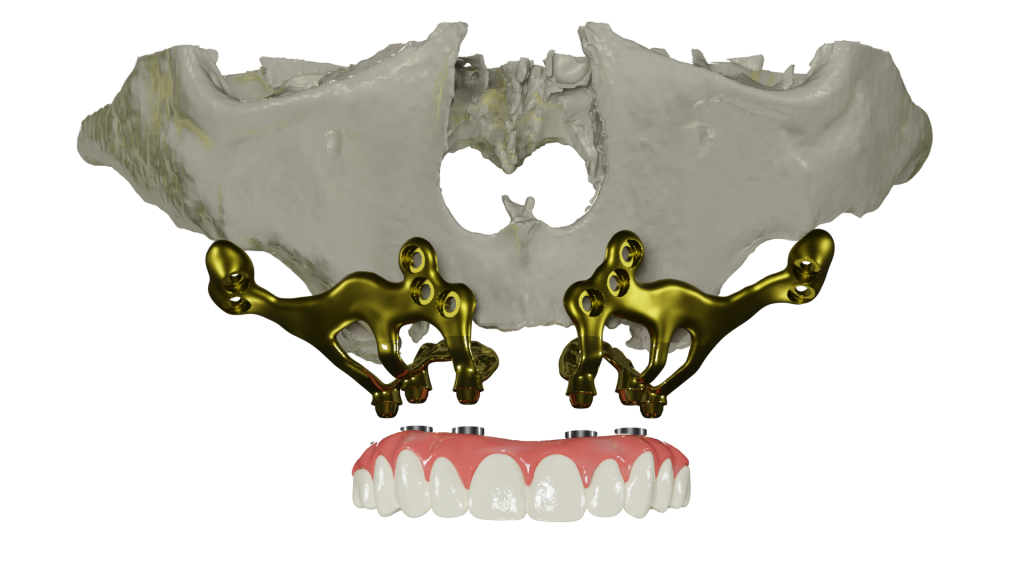 tipos de implantes dentales, implantes yuxtaóseos