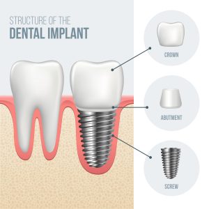 implantes dentales tipos