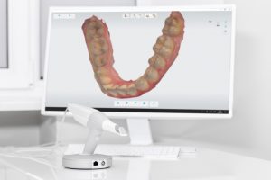 implantes dentales proceso de colocación