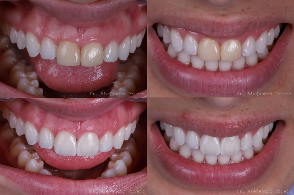fotos carillas antes y después
