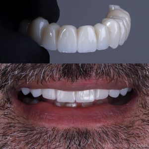 implantes dentales proceso de colocación