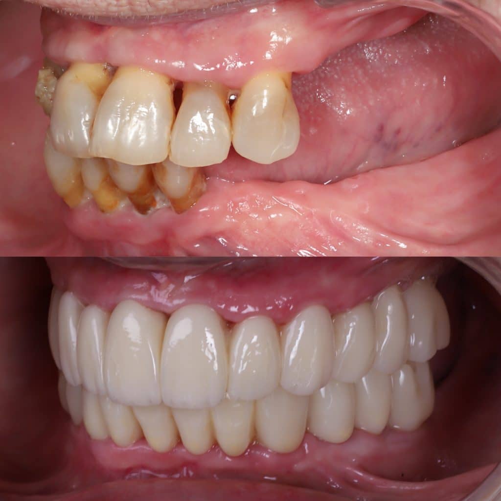 testimonios implantes sin hueso