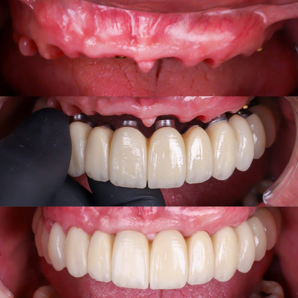 Foto de caso de colocación implantes en arcada superior usando técnica all on 6