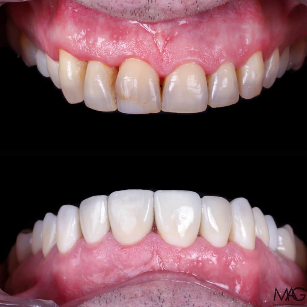 dental implants abroad helvetic clinics or Spain 