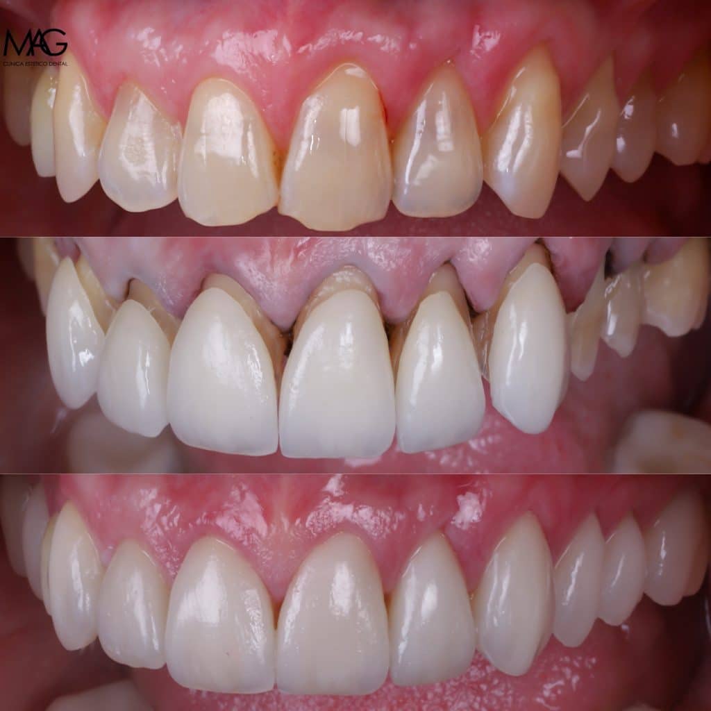 foto de tipos de carillas y carillas de porcelana