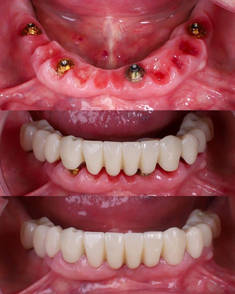 foto de implante completo para prótesis fija sobre 4 implantes