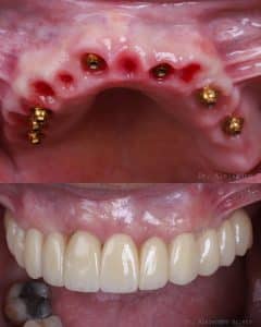 foto de prótesis fija sobre 8 implantes all on 8