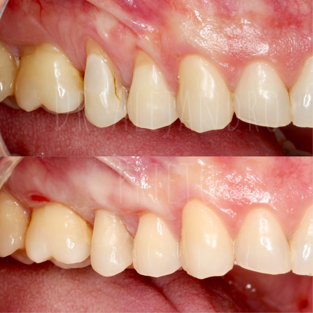 caso real de enc&iacute;as retra&iacute;das