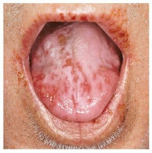 por qu&eacute; salen llagas en la boca Llagas persistentes 