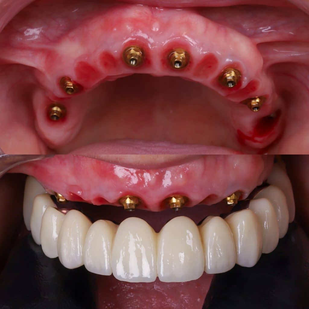 foto de implante dental completo con prótesis fija sobre 6 implantes de carga inmediata