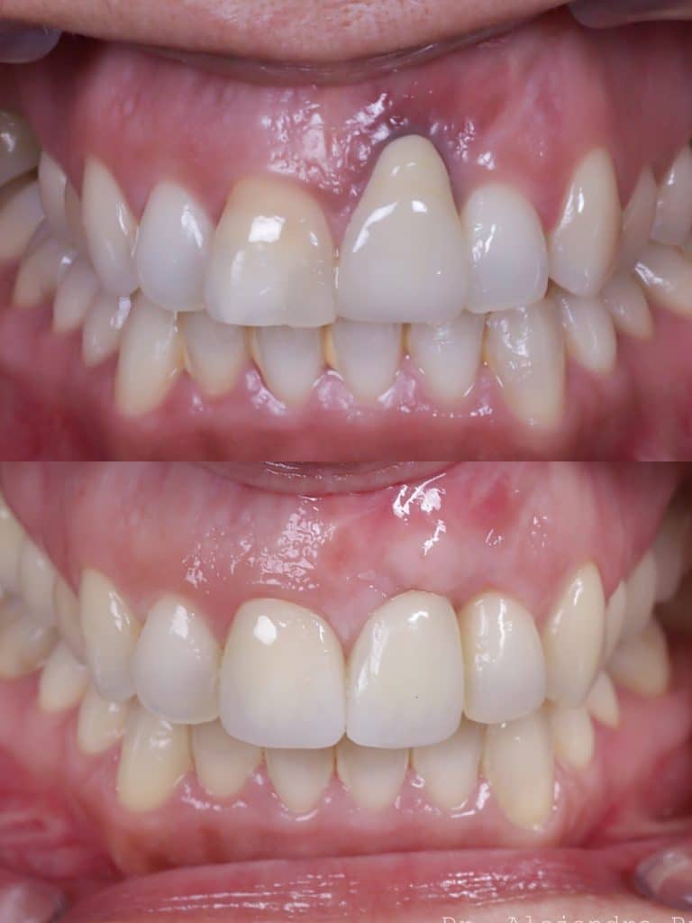 encías retraídas antes y después