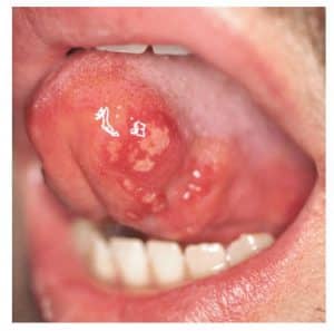 por qu&eacute; salen llagas en la boca Llagas traum&aacute;ticas en la lengua