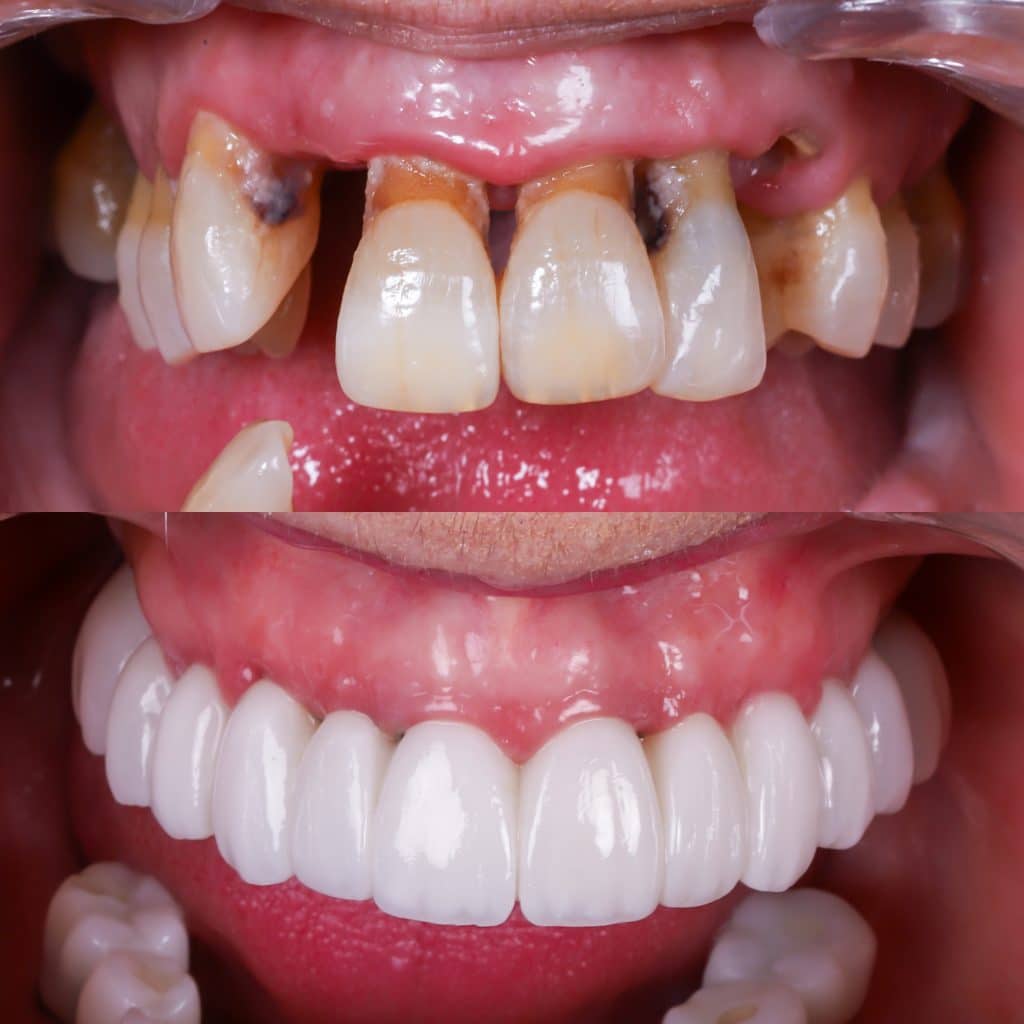 Implantes dentales fotos antes y después 