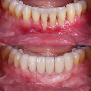 injerto de enc&iacute;a antes y despu&eacute;s