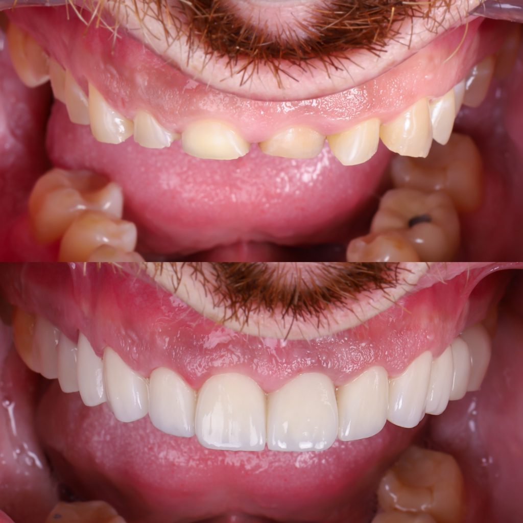 Caso de carillas dentales en bruxismo severo