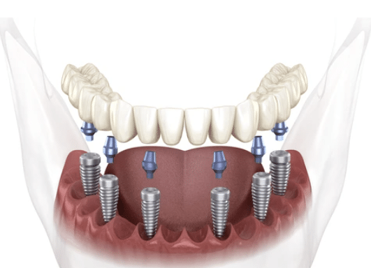 Implantes dentales por arcada