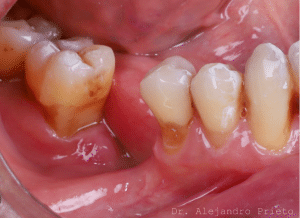 Caso de paciente con falta de hueso antes de regeneraci&oacute;n &oacute;sea para implantes dentales