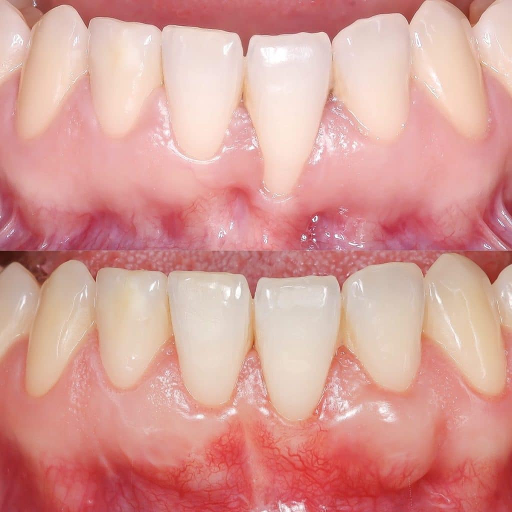 caso de recesi&oacute;n gingival por enc&iacute;as inflamadas