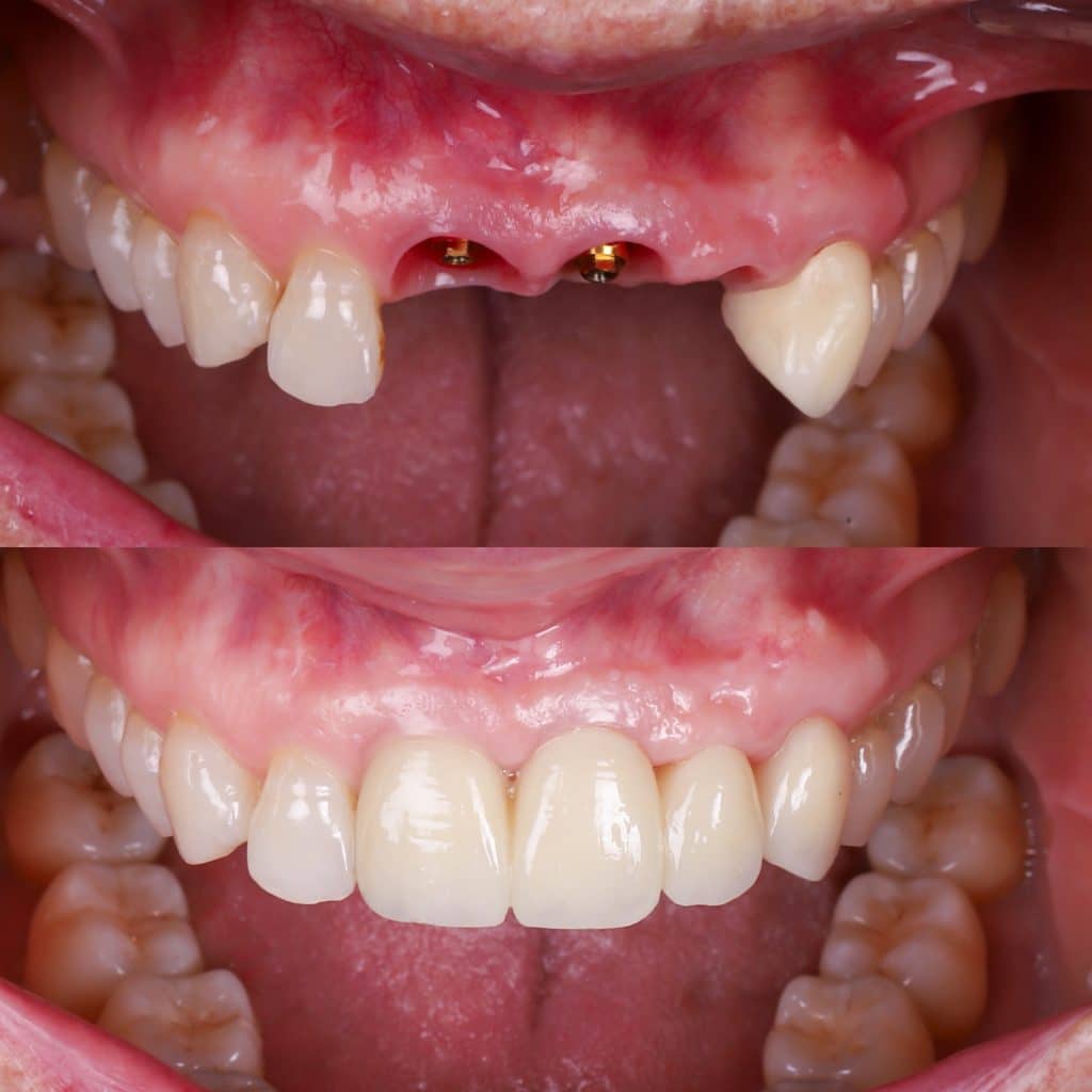 foto de caso real de colocación de implantes dentales en el día en los incisivos superiores