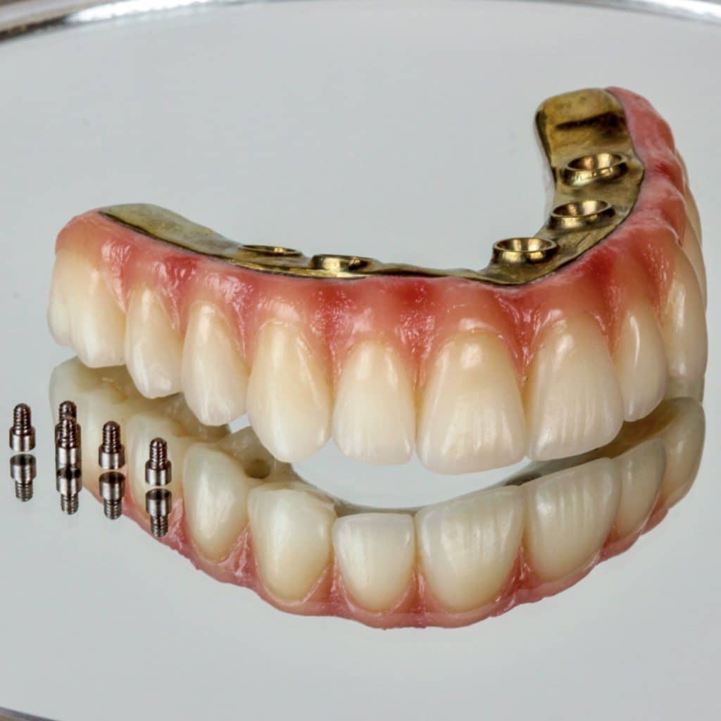 Prótesis dental fija sobre implantes