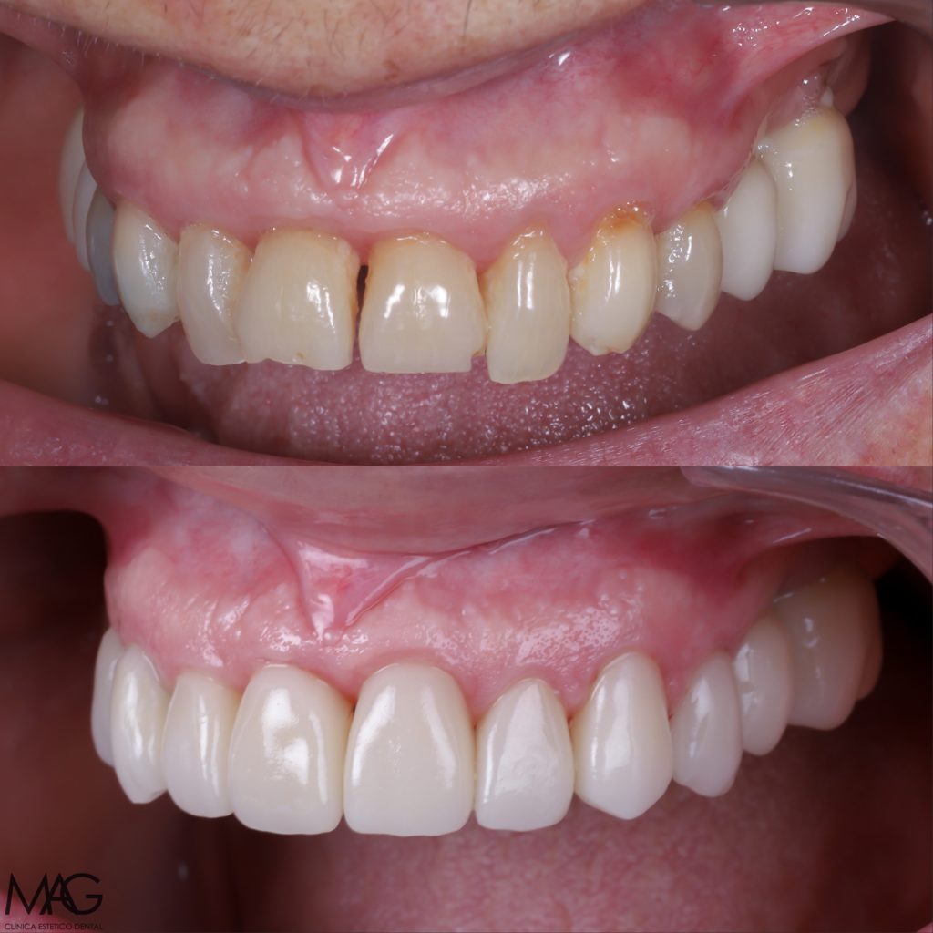 qué son las carillas dentales