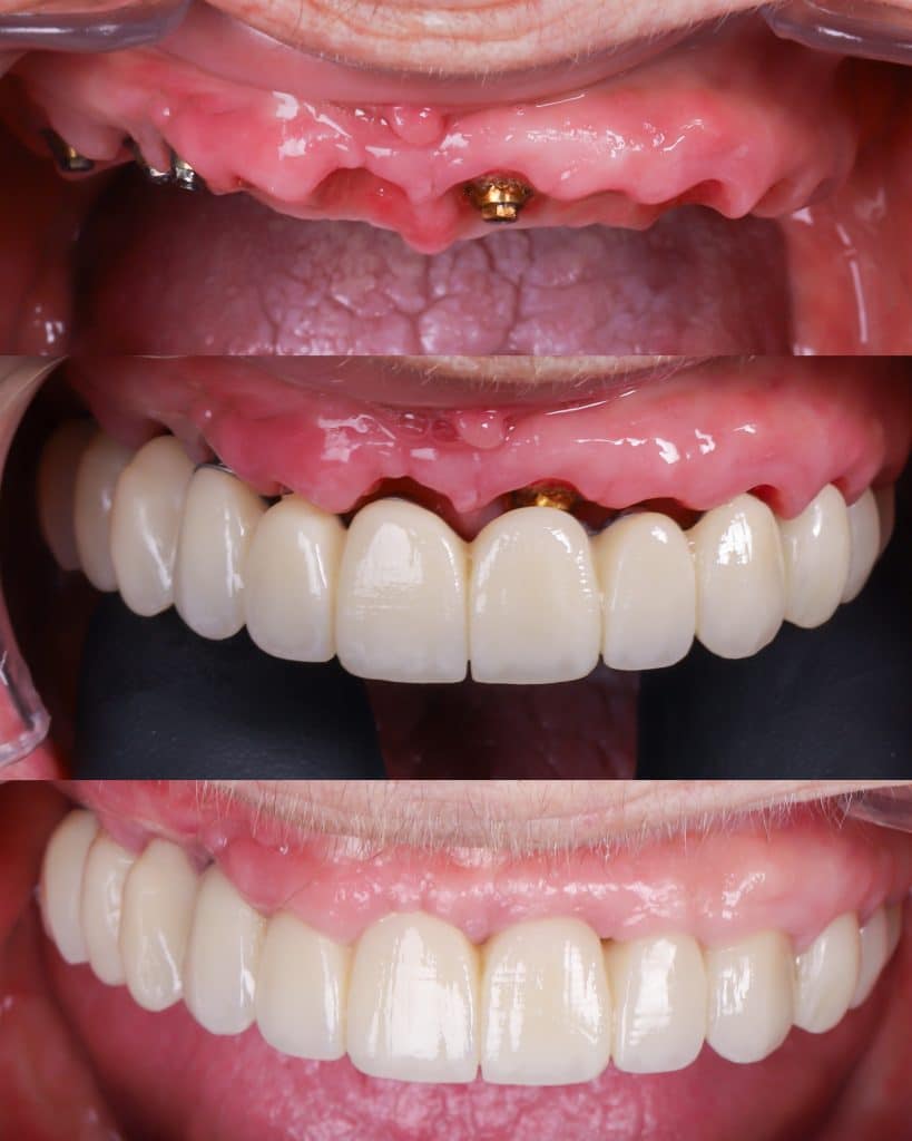 Garantía de implantes con seguro dental 