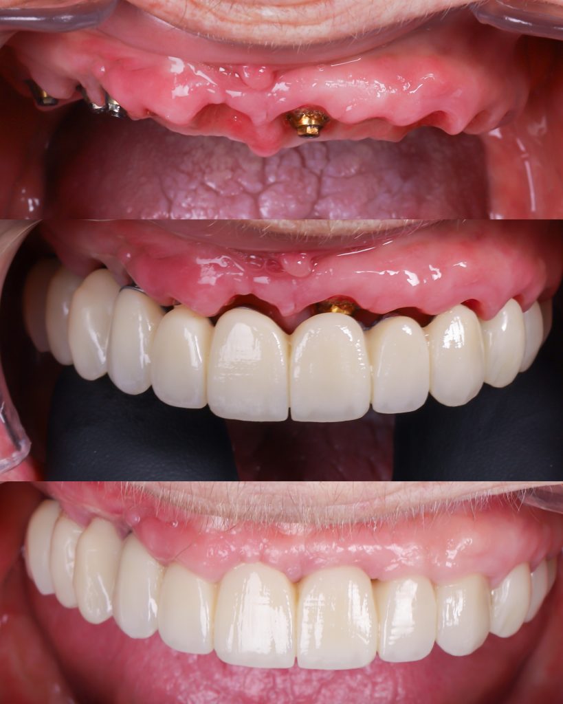 foto implantes dentales toda la boca en el día carga inmediata