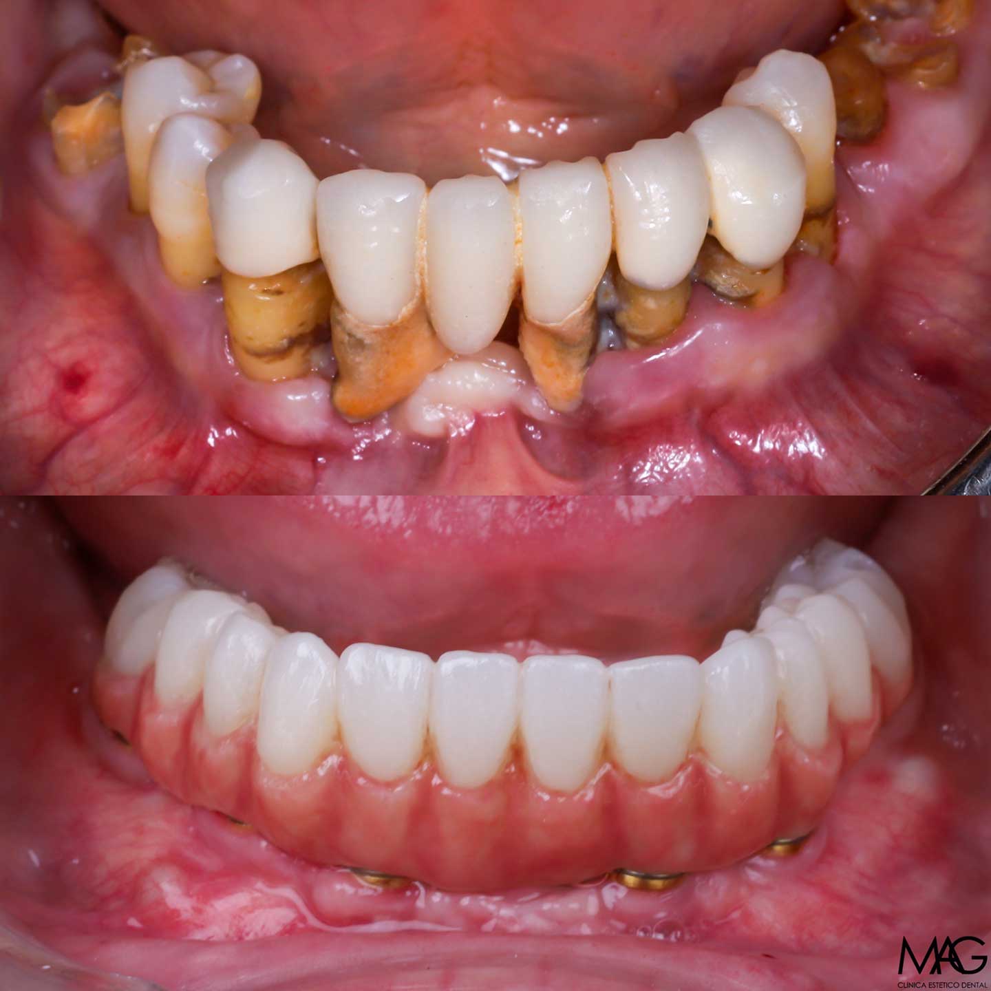 Enfermedad periodontal grave en arcada inferior