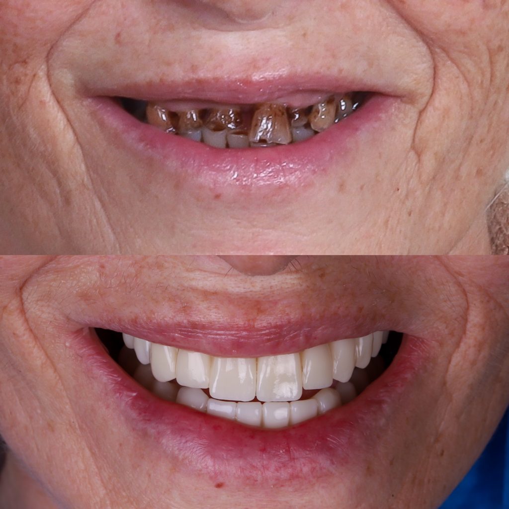 que seguro dental cubre implantes?