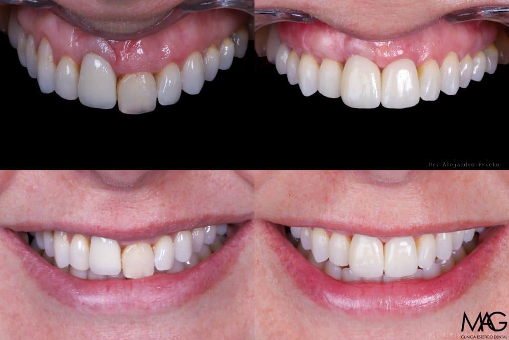 retracción de encias antes y después 