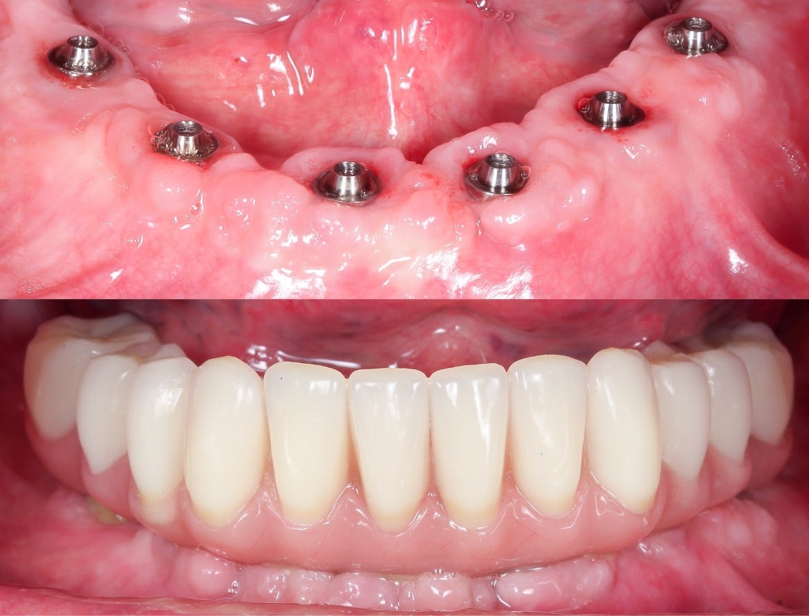 Foto de caso de dentadura fija sobre implantes arcada inferior