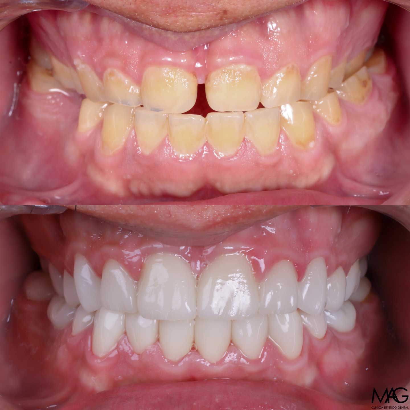 soluci&oacute;n a mordida cruzada antero-posterior