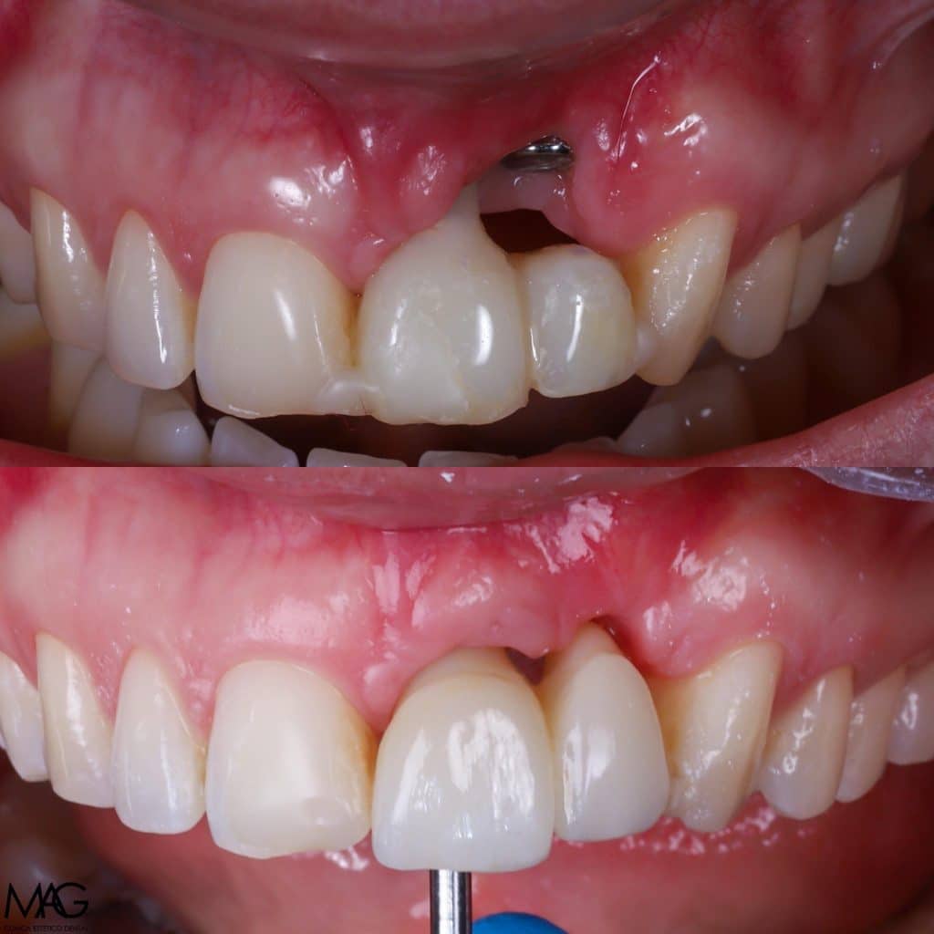 foto antes y después de implantes mal colocados 