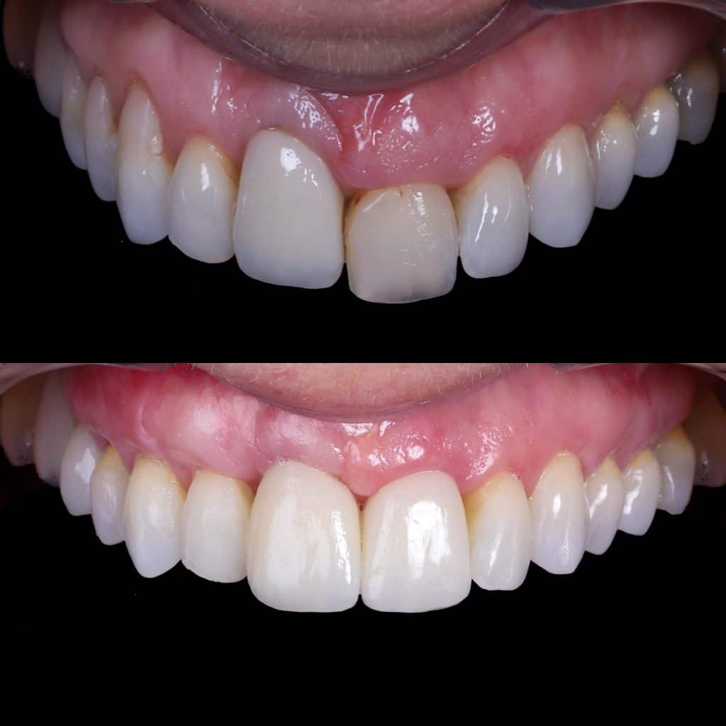 rechazo implante dental mal colocado