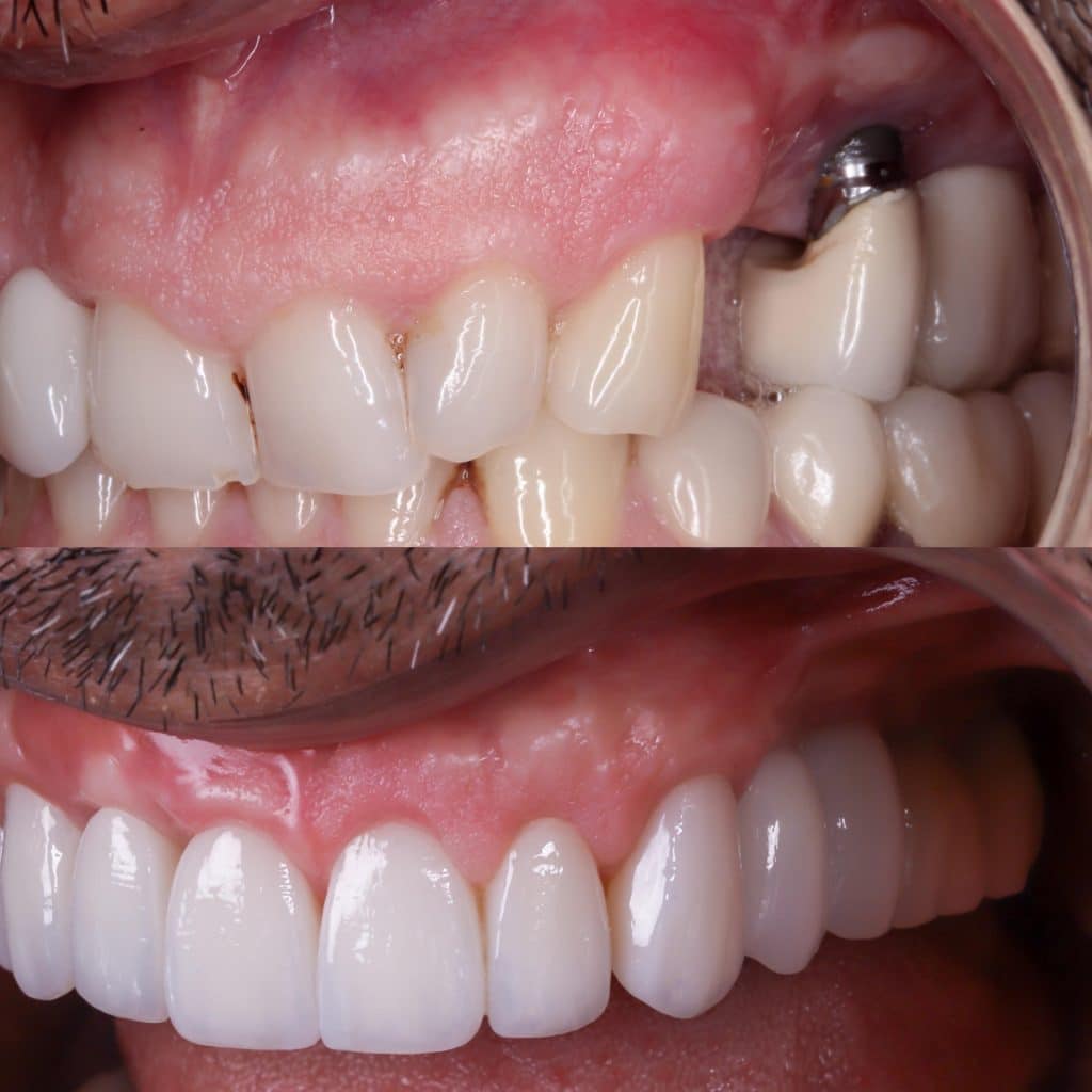 rechazo implante dental después de años​