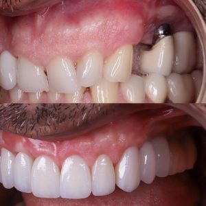 foto de implantes mal colocados con hueco entre implante y enc&iacute;a