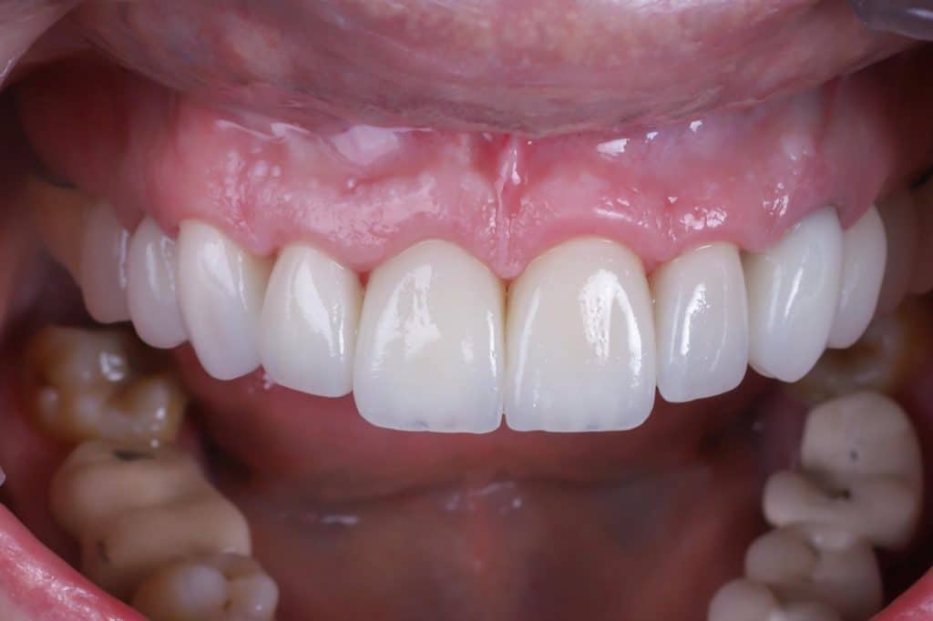 Resultado blanqueamiento dental en clínica