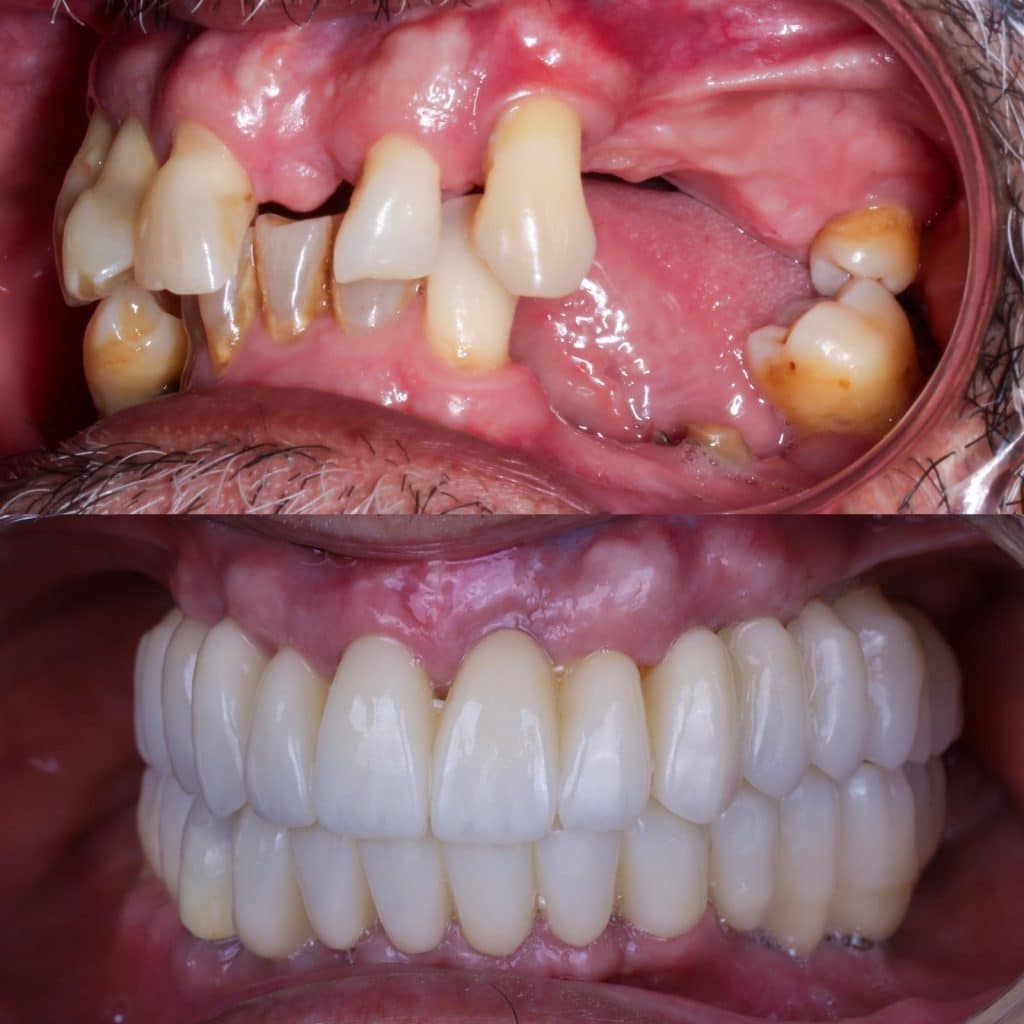 antes y después implantes con regeneración ósea