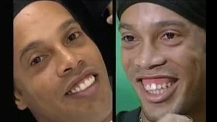 foto antes y después Ronaldinho sonrisa gingival
