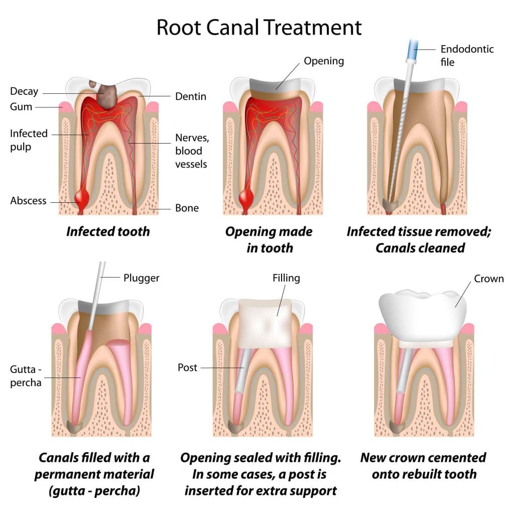 qu&eacute; tomar para el dolor de muelas endodoncia