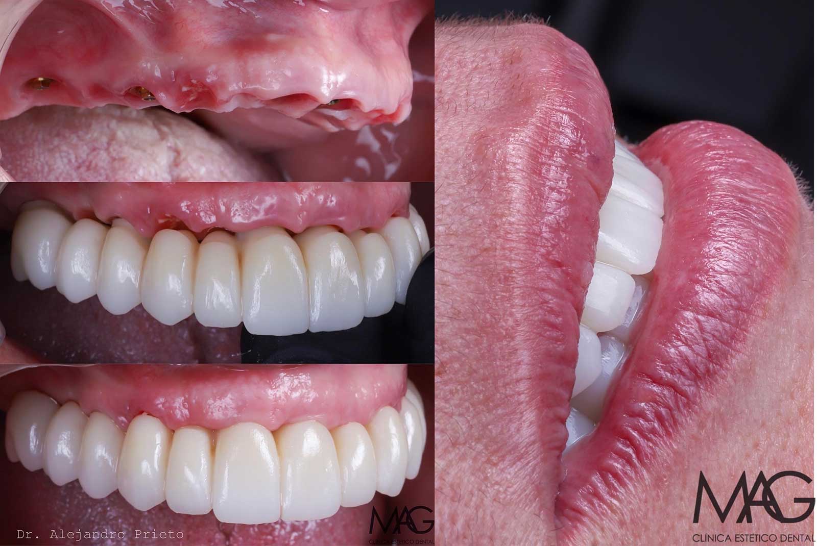 fotos de antes y despu&eacute;s tratamiento de edentulismo